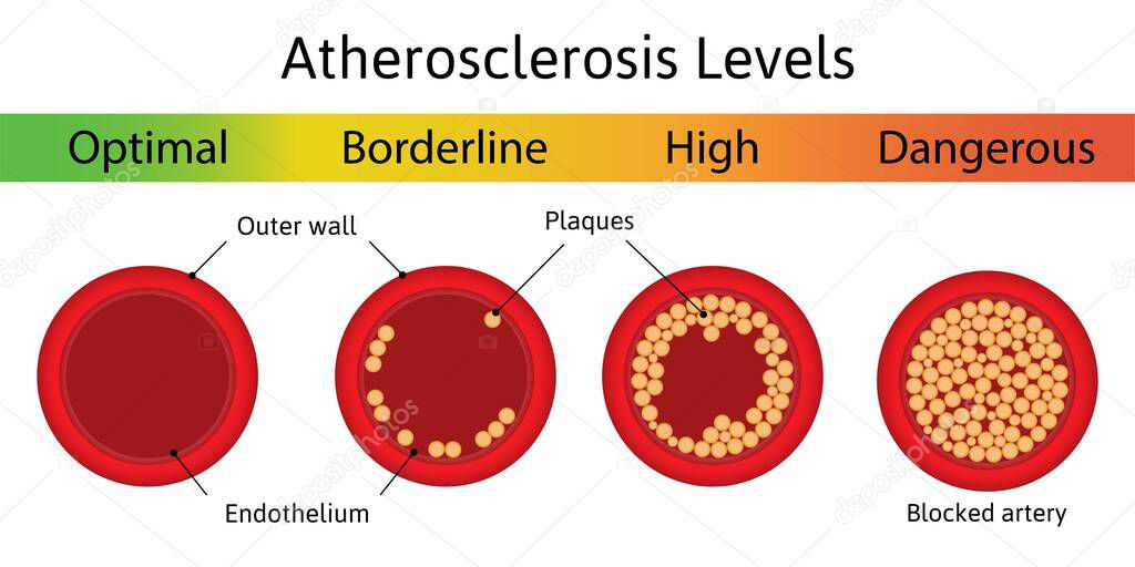 Atherosclerosis levels. The accumulation of cholesterol in the blood vessels. Atherosclerotic plaque. Artery anatomy. Medical vector illustration.