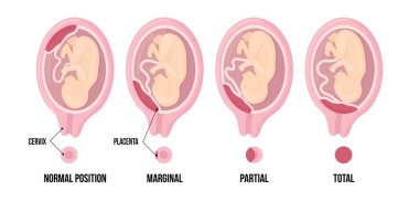 Different Placental Locations During Pregnancy. Normal, marginal, partial and total previa. clipart
