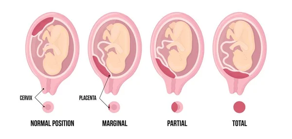 Olika placentaplatser under graviditeten. Normal, marginell, partiell och total previa. — Stock vektor