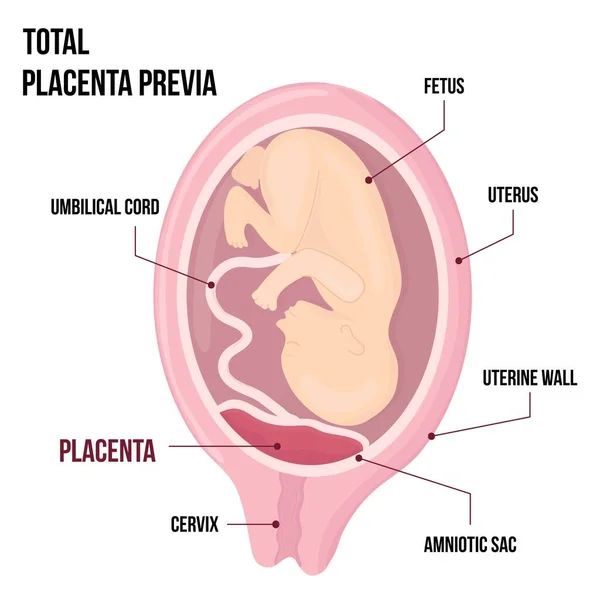 Total Placental previa. Ubicación peligrosa de la placenta durante el embarazo. Patología Médica. diagrama médico detallado con tabla de símbolos. — Archivo Imágenes Vectoriales