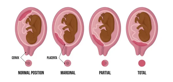 Olika placentaplatser Under afrikansk afroamerikan Graviditet. Normal, marginell, partiell och total previa. svart och brun hud. — Stock vektor