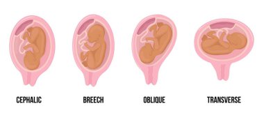 Latin Arap tenli bebek. Hamilelik süresince rahimde farklı yanlış bebek pozisyonları.