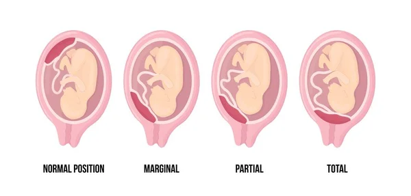 Různé placentární lokace během těhotenství. Normální, okrajové, částečné a celkové previa. — Stockový vektor