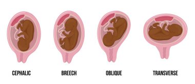 Afrikalı siyah tenli bebek. Hamilelik süresince rahimde farklı yanlış bebek pozisyonları.