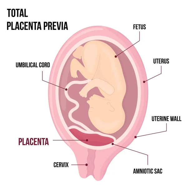 Total Placental Previa Localização Perigosa Placenta Durante Gravidez Patologia Médica — Vetor de Stock