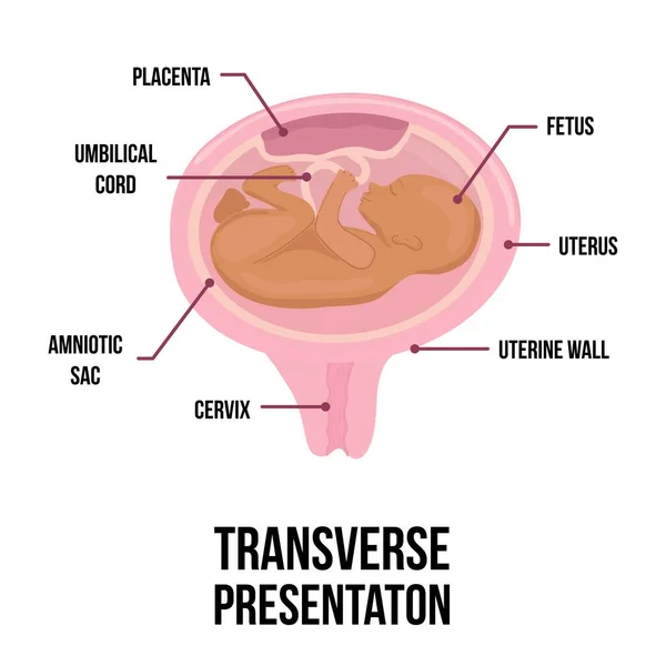 Tvärgående Babypresentation Fel Bebis Positioner Livmodern Graviditeten Färgade Medicinska Vektor Royaltyfria Stockvektorer