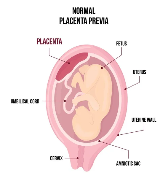 Normális Placenta Previa Szokásos Anatómiai Placenta Elhelyezkedés Terhesség Alatt Stock Illusztrációk