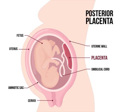 Posterior Plasental previa. Hamilelik sırasında olağan anatomik plasenta konumu. 