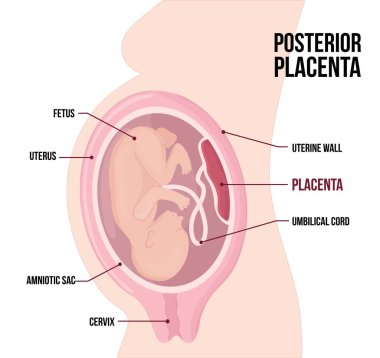Posterior Placental previa. Usual anatomical Placenta Location During Pregnancy.  clipart