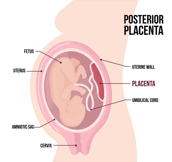 Posterior Placental Previa Usual Anatomical Placenta Location Pregnancy — Vettoriale Stock