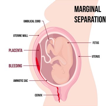 child in womb. Marginal separation of placenta, placental abruption. Vaginal bleeding. Dangerous complication of pregnancy, threat of miscarriage. clipart