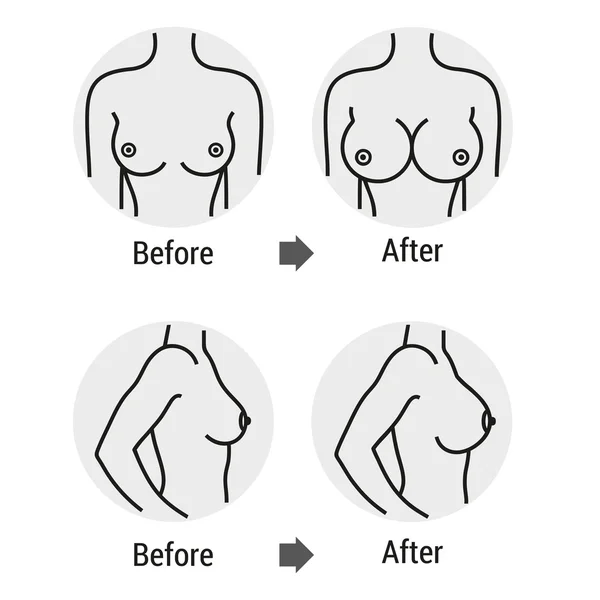 Breast surgery 1 — Stock Vector