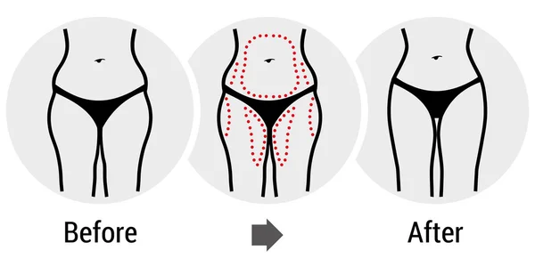 Chirurgie plastique hanches — Image vectorielle