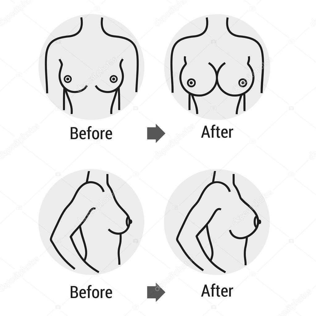 breast surgery 1