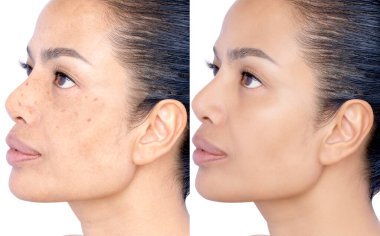 Tedavi öncesi ve sonrası yüz kırışıklıkları, melasma, koyu lekeler, çiller orta yaşlı bir kadının cilt bakımını ve kozmetoloji konseptini ortadan kaldırır. Stüdyo vesikalığı beyaza izole edildi.