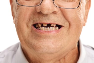 Mouth of a senior man with broken teeth  clipart