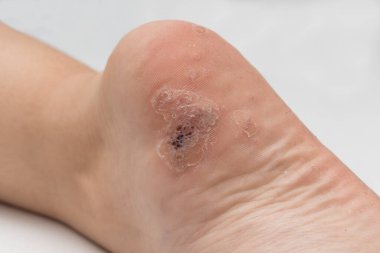 Plantar siğili, insan papillomavirüsü ya da HPV 'nin sebep olduğu ayak topuğunun alt kısmına yakın..