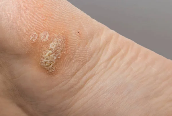Plantar siğil üzerindeki kornea insan papillomavirüsü ya da HPV 'nin sebep olduğu kadın ayak topuğunun altına yakın..