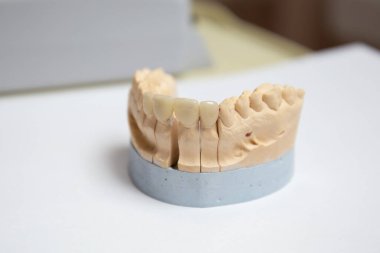 Yapay çenenin saygı duyulan alçı modeli. Estetik dişçilik kavramı ve kaplama tasarımı. Seramik diş kaplamaları.