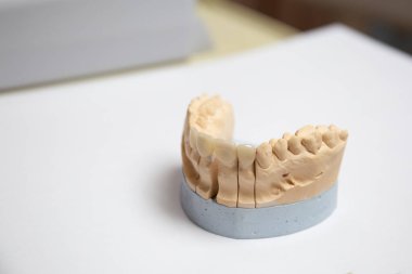 Yapay çenenin saygı duyulan alçı modeli. Estetik dişçilik kavramı ve kaplama tasarımı. Seramik diş kaplamaları.