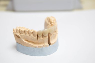 Yapay çenenin saygı duyulan alçı modeli. Estetik dişçilik kavramı ve kaplama tasarımı. Seramik diş kaplamaları.