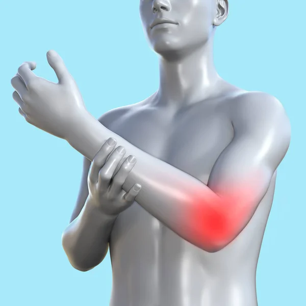 Återge Illustration Manlig Figur Med Röd Inflammerad Armbåge Område Blå — Stockfoto
