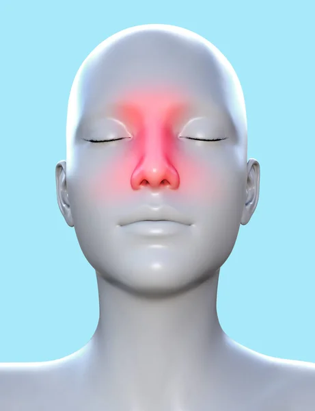 Zilustrowanie Kobiecej Twarzy Czerwonym Zapaleniem Nosowym Niebieskim Tle Koncepcja Kliniki — Zdjęcie stockowe