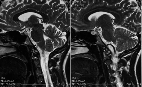 Ressonância Magnética Cérebro Humano Visão Sagital Cerebelo — Fotografia de Stock