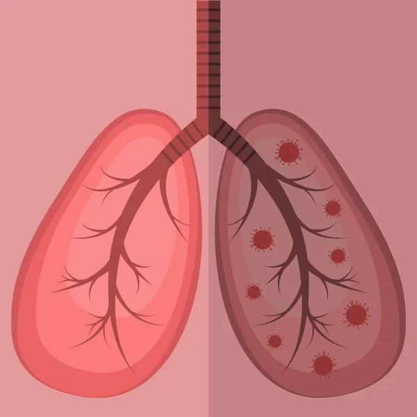 Ilustración Vectorial Con Pulmones Sanos Afectados Por Virus Virus Corona — Archivo Imágenes Vectoriales