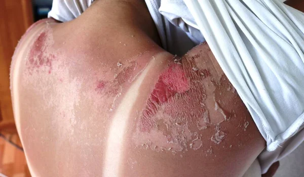 a strong tan on a woman\'s back with injured areas and damaged skin, the consequences of a long exposure to the sun without applying sunscreen on the example of a girl\'s body