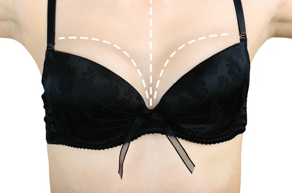 Отметки на груди женщины перед пластической операцией — стоковое фото