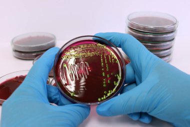Bilim adamı Escherichia coli (E.coli) kültürünü Petri kabında Eosin Metilen Blue (EMB) Agar ile inceleyerek, tıbbi laboratuvarda azot eldivenleriyle el ele tutuşan metalik yeşil parıldayan kolonileri gösterdi..