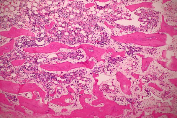 アデノイド嚢胞性がんの顕微鏡は 多くの異なる部位にまれな種類のがんが存在する この腫瘍は唾液腺で発生し クローズアップマクロ40倍レンズ 微生物学研究室の概念 — ストック写真