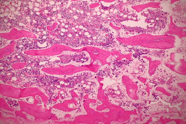 Microscopio Carcinoma Quístico Adenoide Tipo Raro Cáncer Existe Muchos Sitios Imagen de stock