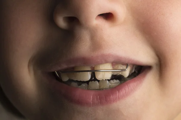 Chica con un aparato dental de ortodoncia — Foto de Stock