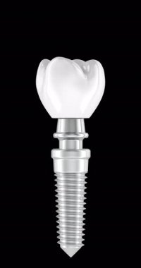 Diş implantı birleştirme ve parçalama animasyonu kusursuz bir döngüde. Şeffaf arkaplanda 3B görüntüleme izole edildi