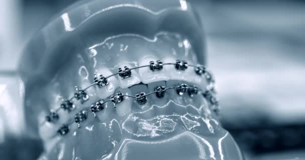 Bretelle su denti artificiali primo piano, odontoiatria dentale — Video Stock