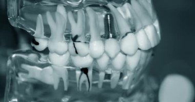 Yakın plan implantları olan şeffaf İnsan Dişleri Modeli