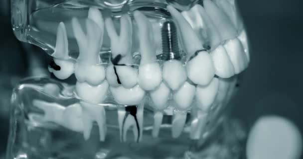 Прозора модель зубів людини з імплантатами крупним планом — стокове відео