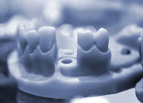 Dişleri ve implant kaplaması için delikleri olan katlanabilir çene modeli — Stok fotoğraf