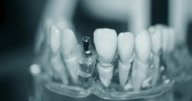 Yakın plan implantları olan şeffaf İnsan Dişleri Modeli