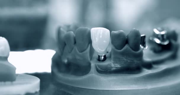 インプラントクラウン用の歯と穴を備えた折りたたみ式顎モデル — ストック動画