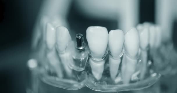 Transparent modell av mänskliga tänder med implantat närbild — Stockvideo