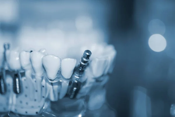 Modelo transparente de dientes humanos con implantes de primer plano. — Foto de Stock