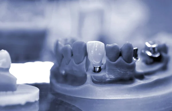 Modelo de mandíbula plegable con dientes y orificios para el pilar de la corona del implante — Foto de Stock