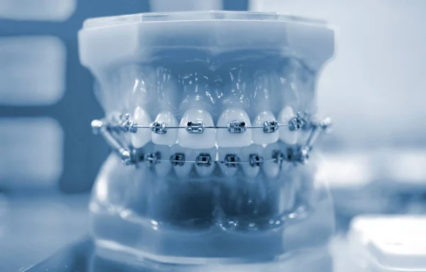 Tirantes en mandíbulas de dientes artificiales de cerca, odontología dental — Foto de Stock