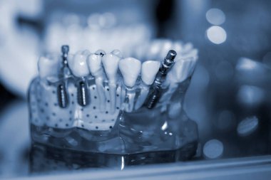 Yakın plan implantları olan şeffaf İnsan Dişleri Modeli.