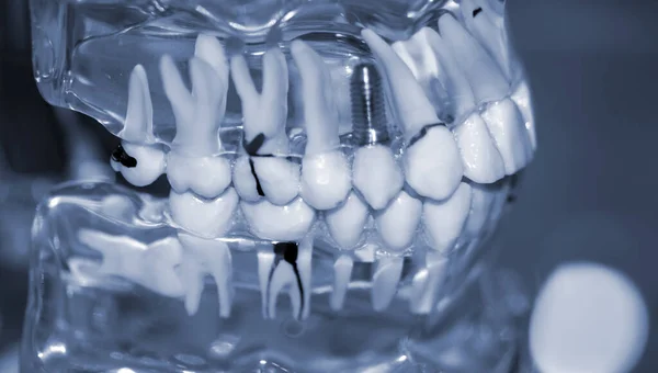 Modelo transparente de dientes humanos con implantes de primer plano. —  Fotos de Stock