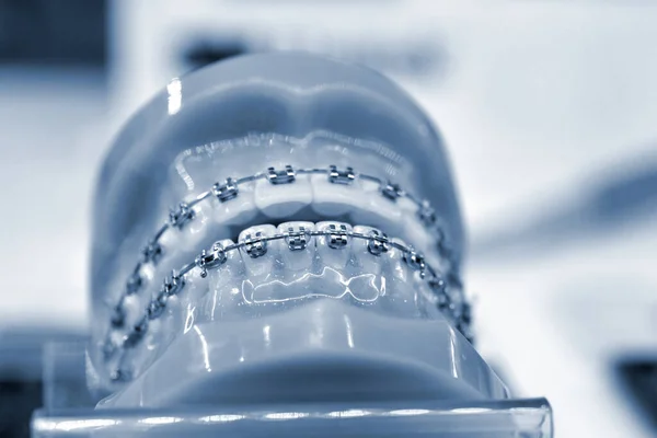 Braces on the model of human jaws — Stock Photo, Image