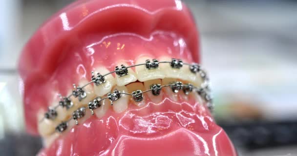 Брекеты на искусственных зубах крупным планом. Стоматология зубов. Брекеты для зубов. — стоковое видео